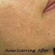 Acne Scarring after Treatment with Nature Peel