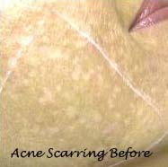 Acne Scarring before Treatment with Nature Peel